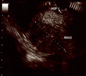 An endoscopic ultrasound showing the dominant mass in the head of Dr. Lewis’ pancreas.