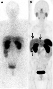 Gallium 68 PET/CT scan compared to Octreoscan 