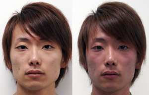 Young Asian man with normal skin one, then a photo of him with flushed or red faced. 